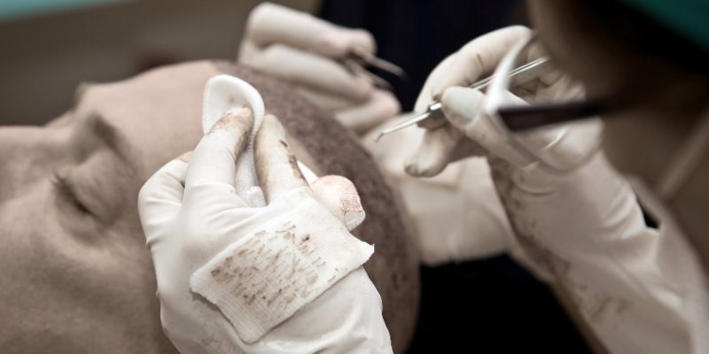 BestHairClinic: What are the Differences Between FUE and DHI?