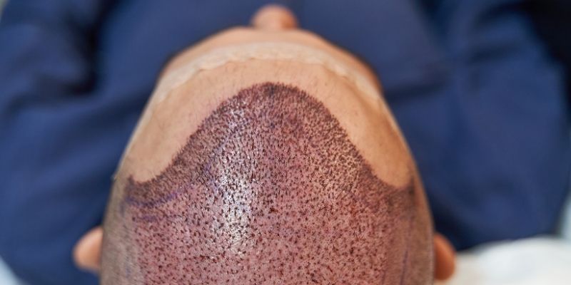 The First 1 Month Recovery Process After Hair Transplant