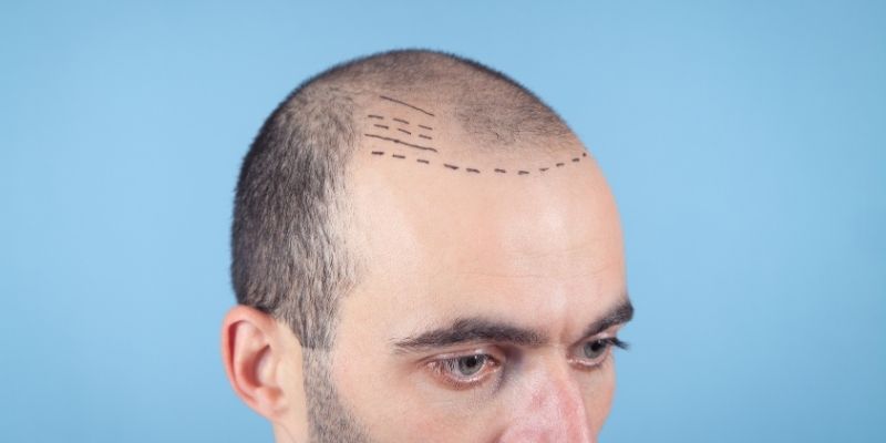 Things to Do Before a Hair Transplant