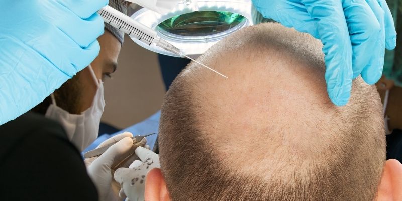 Is Shock Loss Normal After Hair Transplant?