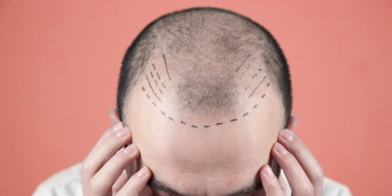 When to Return to Normal Life After Hair Transplant?