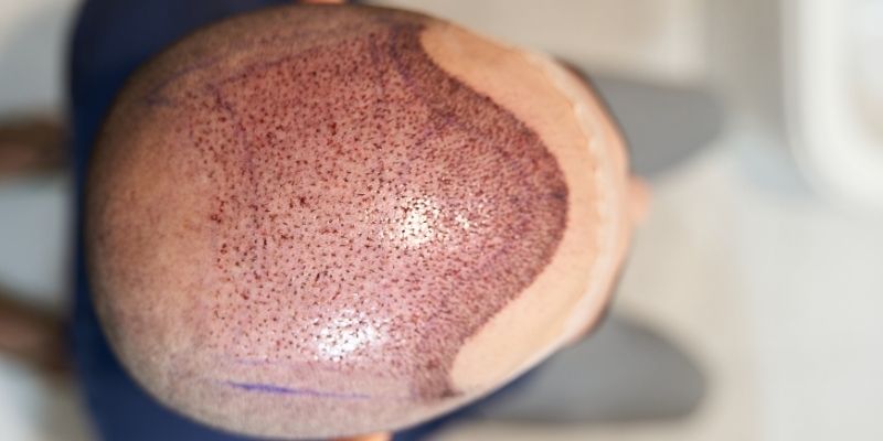 How is the Number of Grafts Determined in Hair Transplant?