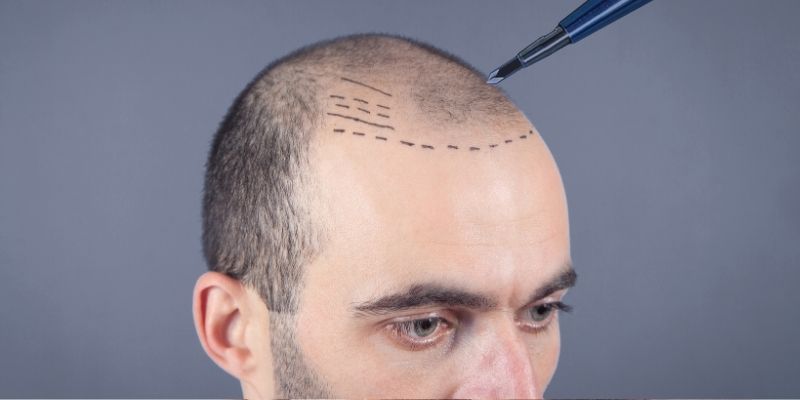 What is Sapphire FUE Technique? What are its Advantages?